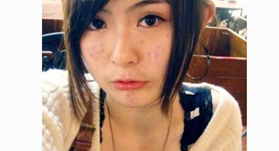 教你改善痘痘的3种方法,痘痘怎么消除小妙招不花钱