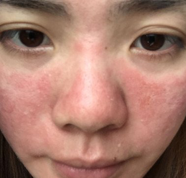 脸上起红疹是什么原因引起,脸上起红疹是什么原因引起的