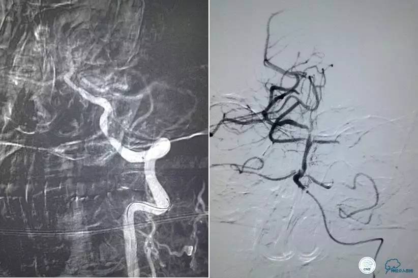 急性缺血性卒中静脉溶栓2018指南,急性缺血性卒中血管内再通标准
