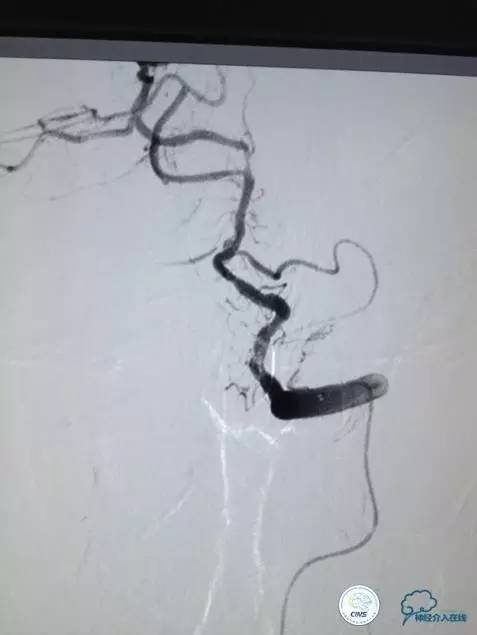 急性缺血性卒中静脉溶栓2018指南,急性缺血性卒中血管内再通标准