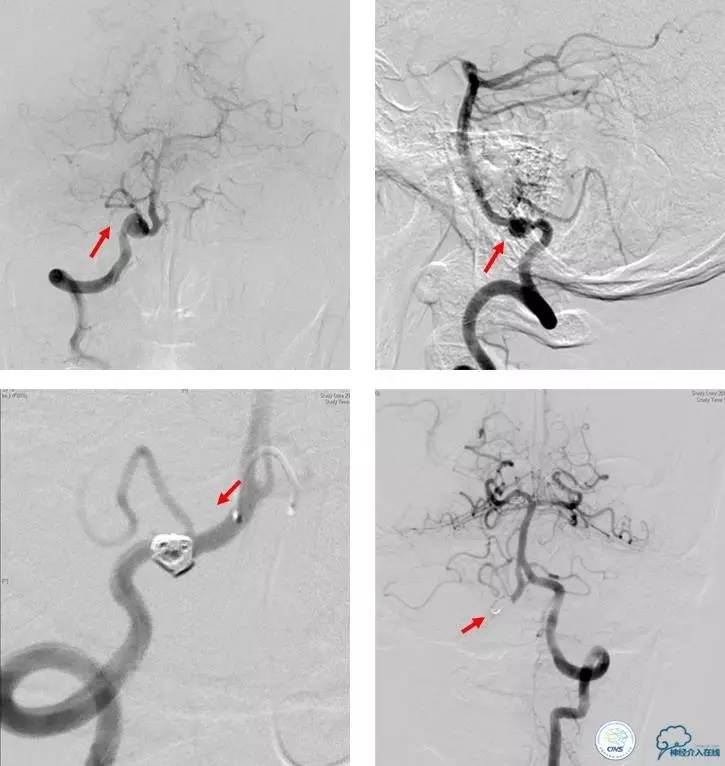 颈椎压迫椎动脉按摩正骨行吗,按摩斜角肌会导致椎动脉夹层吗