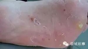 湿疹痒痒如何缓解,湿疹痒痒处能拍打么