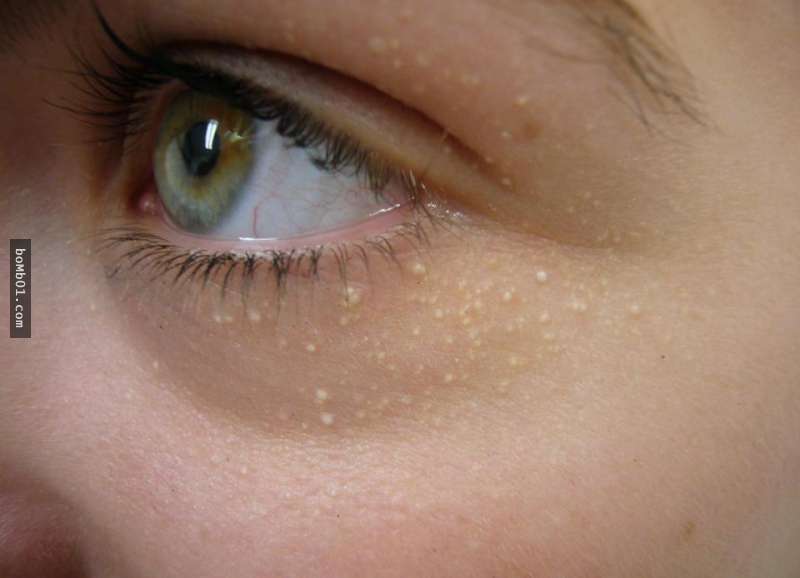 能去脸部小肉球的药膏,面部小肉球怎么去除简单方法