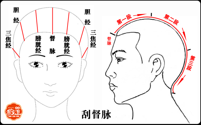 偏头痛刮痧眼睛有点肿了,眼睛干涩刮痧刮哪里