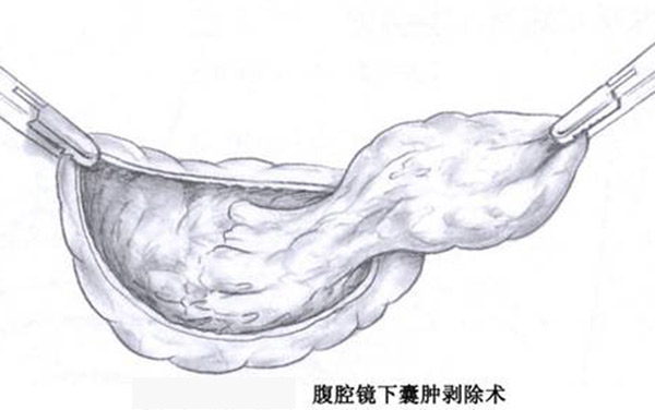 卵巢疾病的注意事项,卵巢囊性肿瘤注意事项