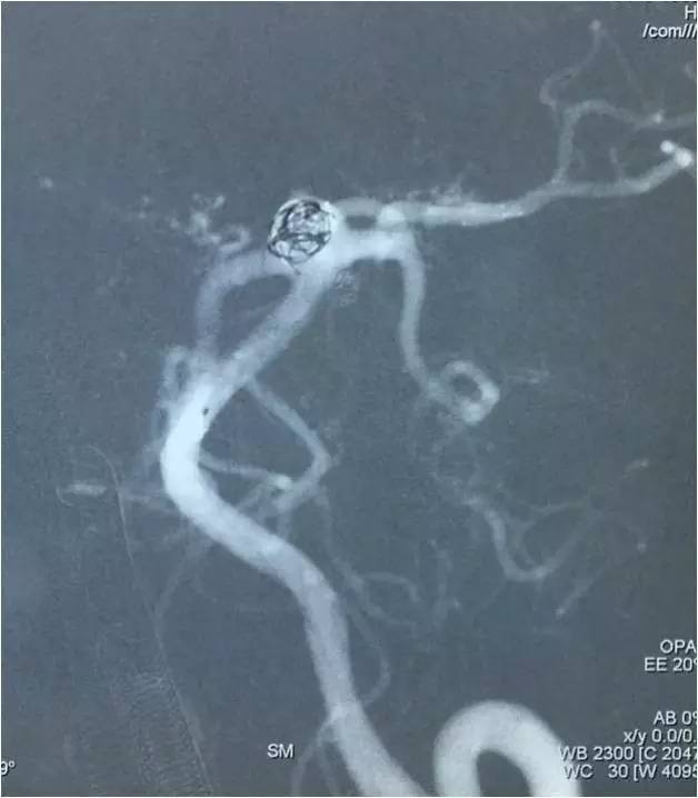 基底动脉顶端动脉瘤加左侧小脑上动脉瘤以Y型支架结合弹簧圈栓塞