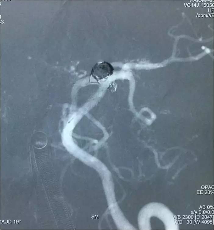 基底动脉顶端动脉瘤加左侧小脑上动脉瘤以Y型支架结合弹簧圈栓塞
