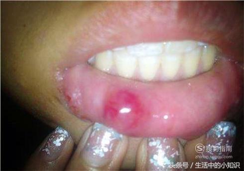 嘴上起泡怎样快速下去,感冒嘴上起泡怎么快速消除