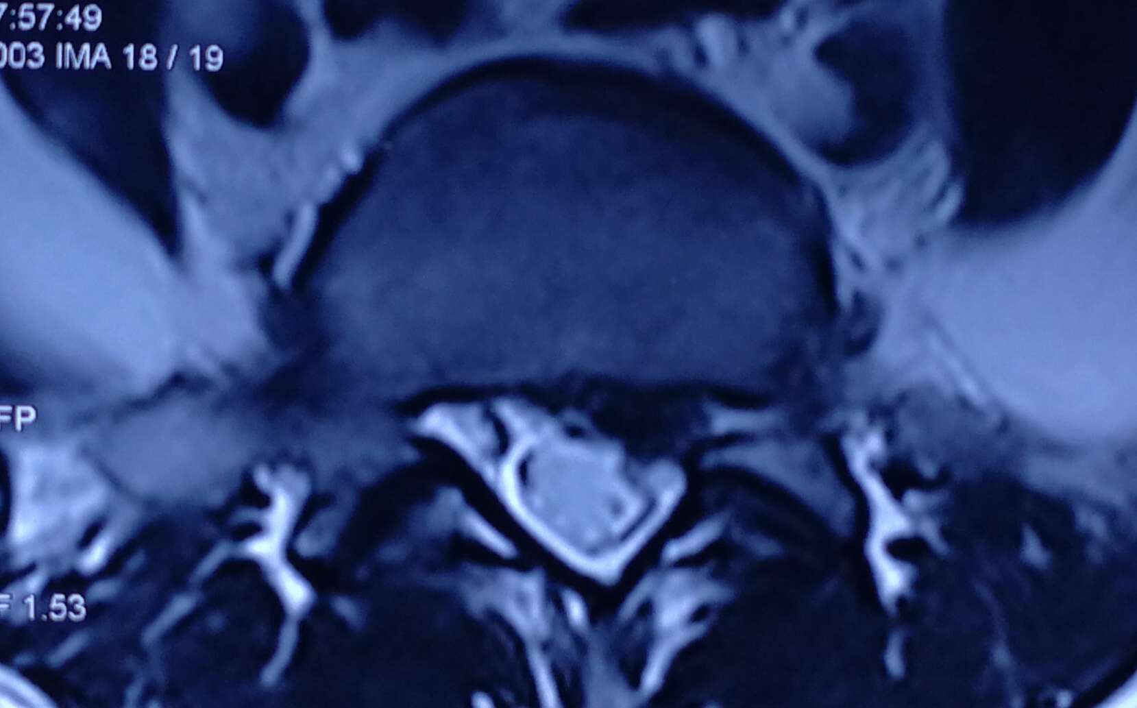 美女们，我该如何去拯救你们椎间盘突出的腰？
