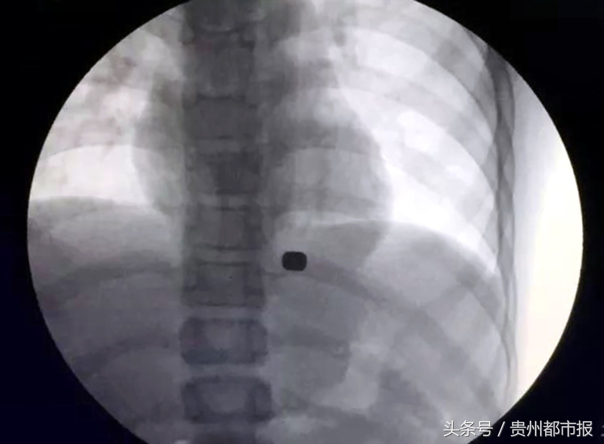 小孩误吞两厘米长椭圆形磁铁,小孩误吞1颗磁铁珠怎么办