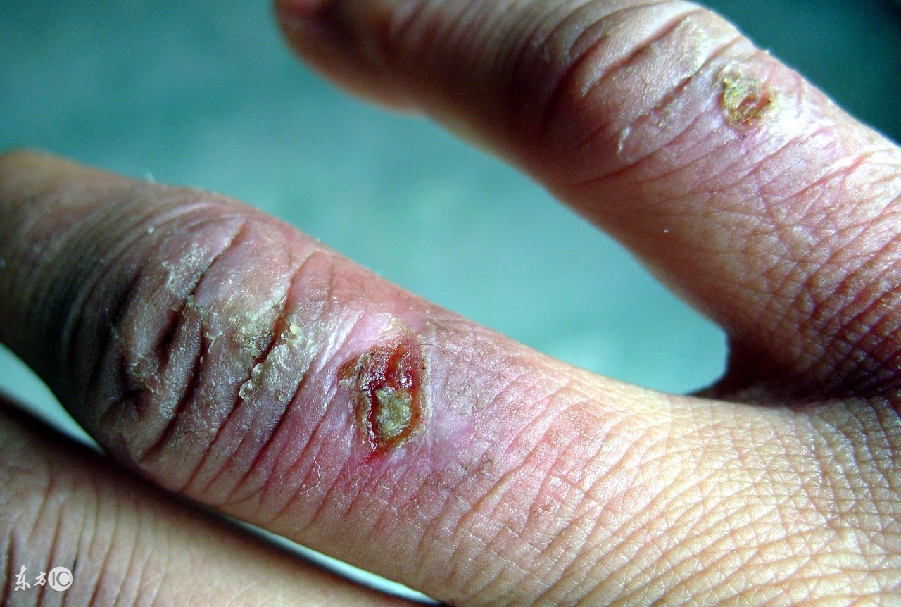 甘油治冻疮的中成药,治疗冻疮的内服中成药