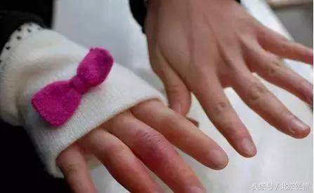 冻手冻脚怎么治疗除根,怎么冻手冻脚的