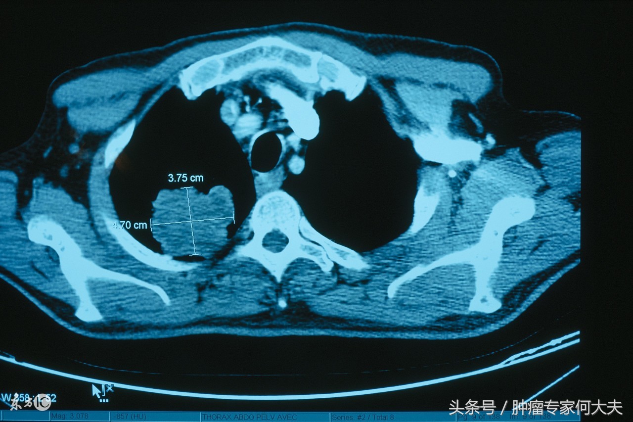 误诊误治导致癌症晚期死亡,癌症误诊是医疗过错吗