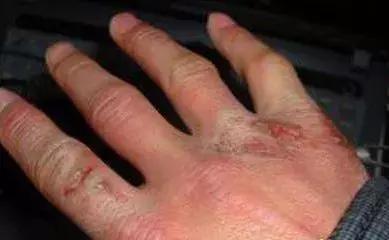 冻疮有特效膏药吗,治冻疮最快的药方