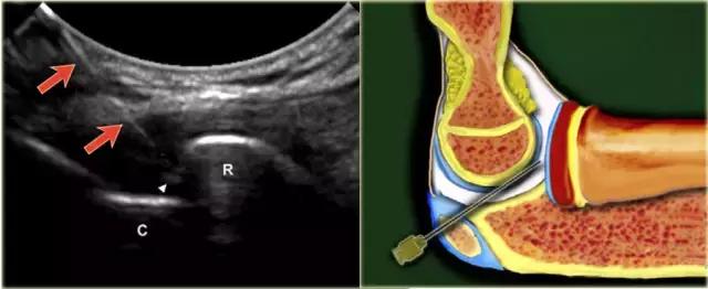 超声引导穿刺和介入穿刺的优缺点,关节超声引导