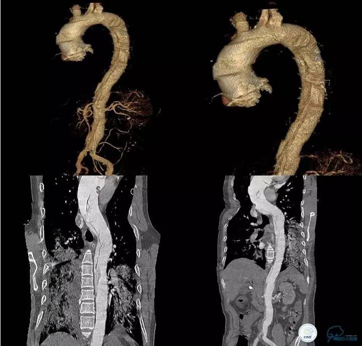 主动脉夹层引起的脑梗后遗症,颈动脉狭窄缺血性脑梗