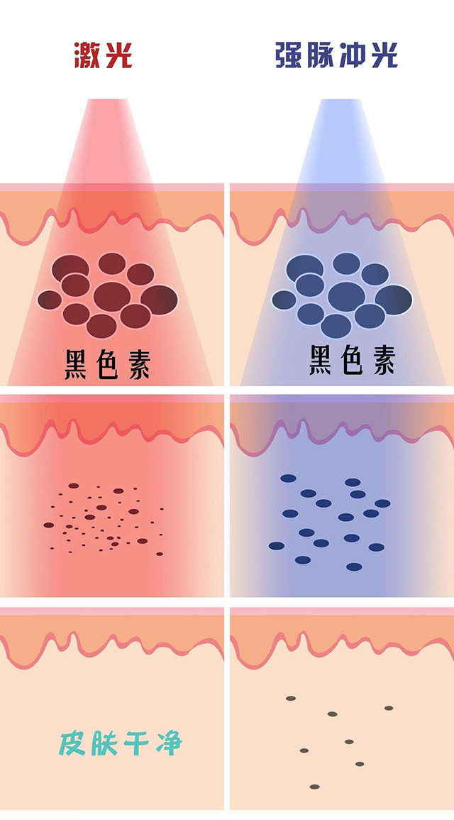 去看皮肤科治疗雀斑问什么问题,去医院什么科治疗雀斑