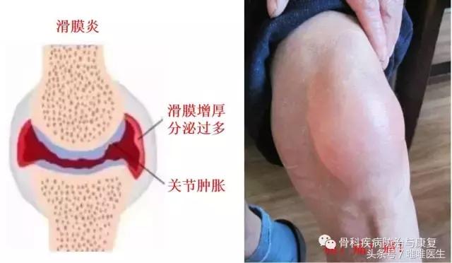 武汉骨科滑膜炎去哪里看最好,骨科专家滑膜炎是什么症状
