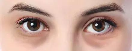 长期熬夜造成的熊猫眼要如何消掉,严重黑眼圈十年变成熊猫眼怎么办