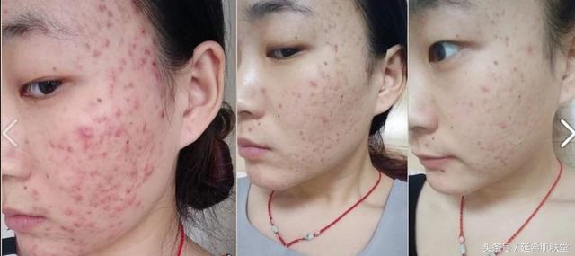 换季长痘是什么原因怎么处理,一到换季就长痘怎么回事