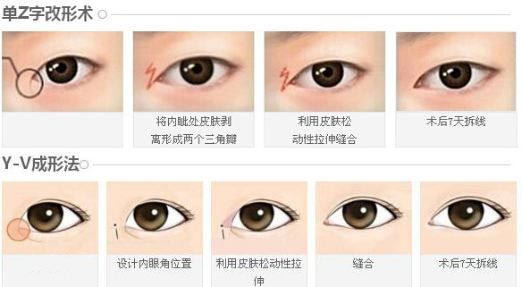 开内眼角攻略,开内眼角都需要了解哪些方面