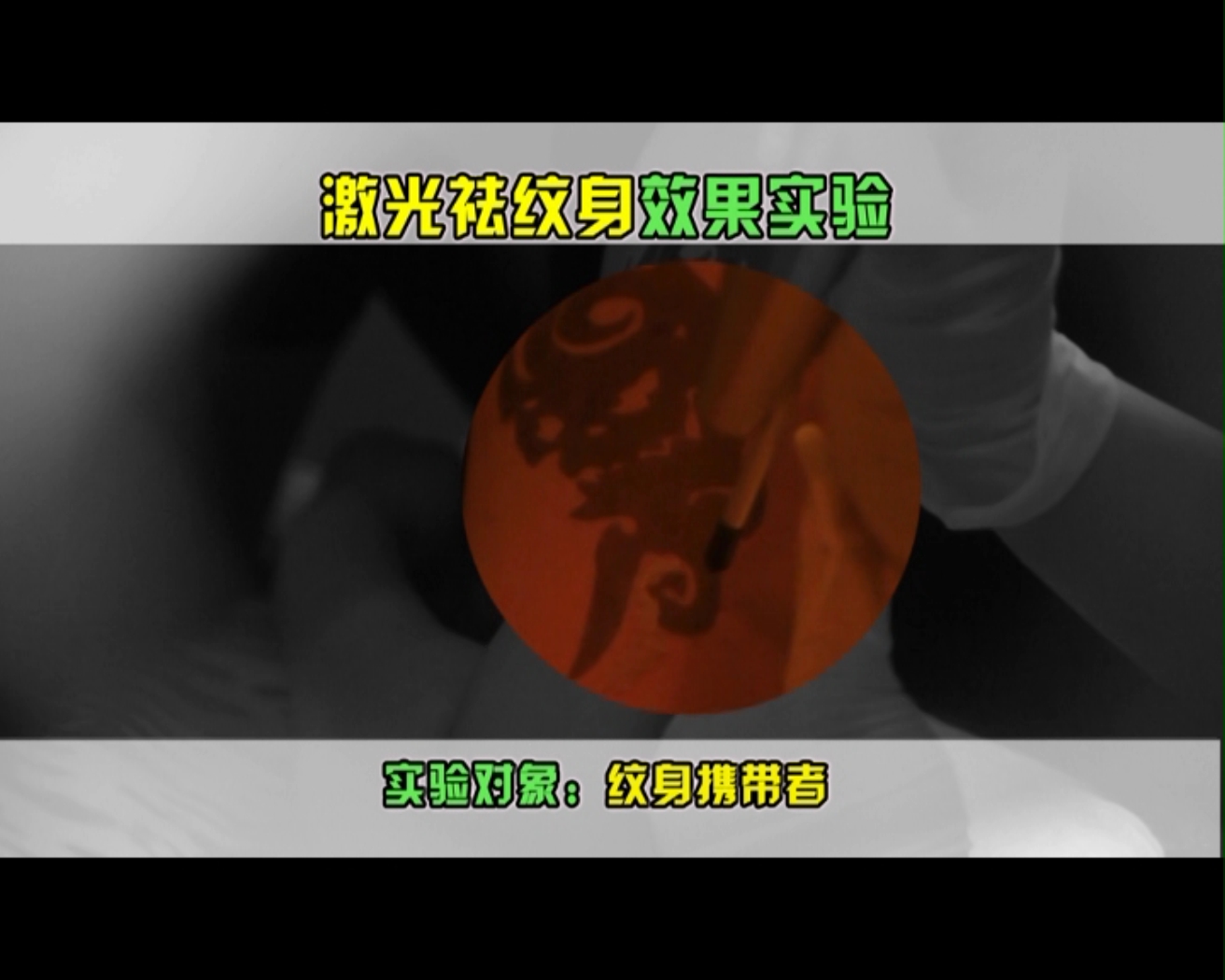 激光去除纹身的疤痕效果怎么样,激光祛除纹身有副作用