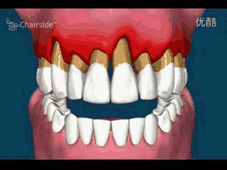 戴牙套牙齿会松动嘛,戴牙套牙齿会往里凹嘛