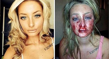 打架脸肿了怎么处理,打架脸肿怎么处理