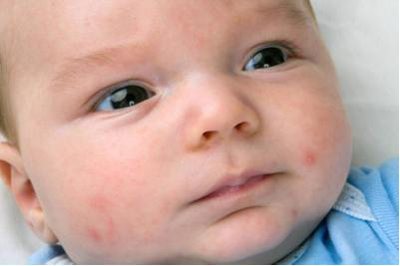 引起宝宝湿疹的原因和解决方案,宝宝容易长湿疹妈妈应该注意什么