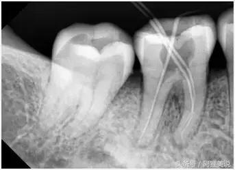 根管治疗最后补牙单独收费的吗,根管治疗最后一步需要多少钱