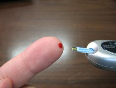 糖尿病病例分享100例,糖尿病患者不吃药三年并发症病例