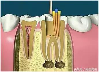根管治疗最后补牙单独收费的吗,根管治疗最后一步需要多少钱