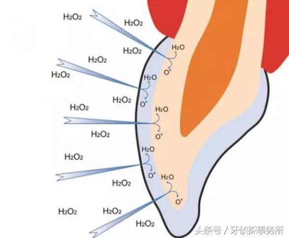 牙齿美白和冷光美白有啥区别,牙齿黄了很多年冷光美白仪有用吗