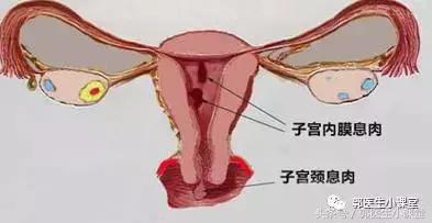 豆浆喝多了会得子宫内膜癌吗,豆浆喝多了容易得子宫肌瘤吗