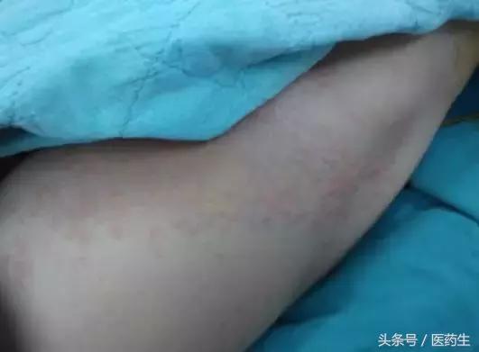 遇到过敏性休克我们应该做什么,预防接种过敏性休克处置原则