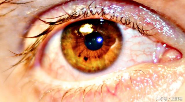 眼睛出现血丝怎么解决,眼睛有血丝发红怎么回事