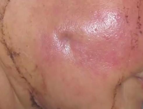 骨髓炎反反复复七年了怎么治疗,下颌骨骨髓炎手术后半年复发