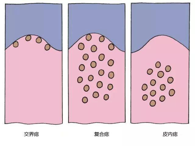 乳房上长的痣可以用激光点掉吗,什么样的痣适合激光点痣