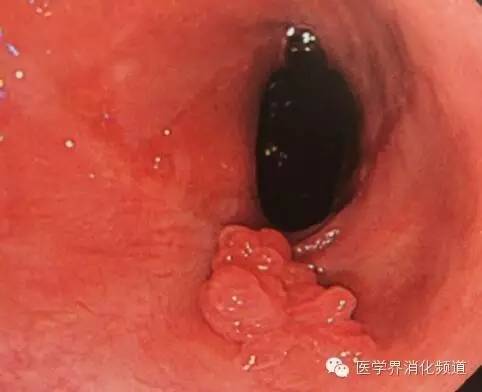 食管良性肿瘤科普视频,食管乳头状瘤和增生区别