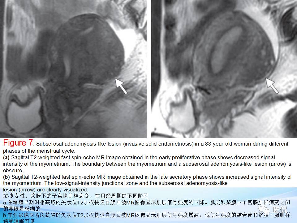双语PPT：子宫腺肌症常见和不常见的MRI表现医学影像