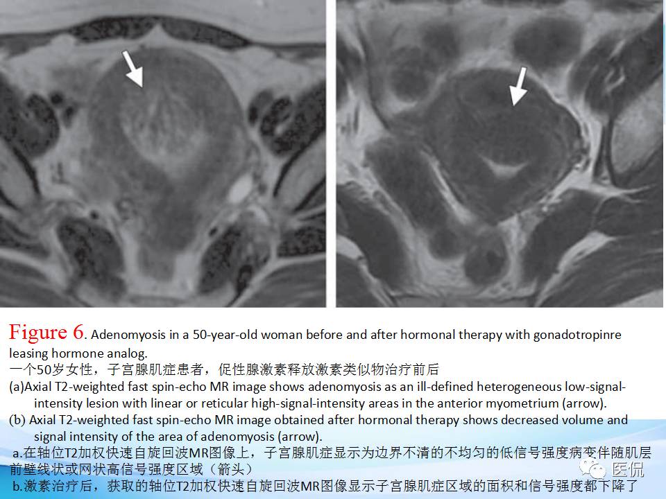 双语PPT：子宫腺肌症常见和不常见的MRI表现医学影像