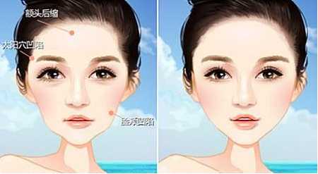 颧骨高填充好还是磨骨,颧骨高自体脂肪填充