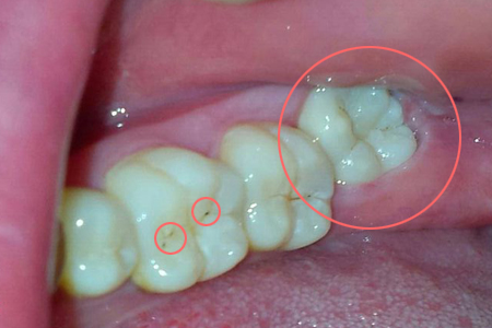 智齿发炎为什么不能拔牙,智齿发炎为什么不能割牙龈