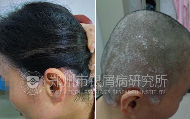 银屑病绝不能忌口,银屑病真的不能用激素么