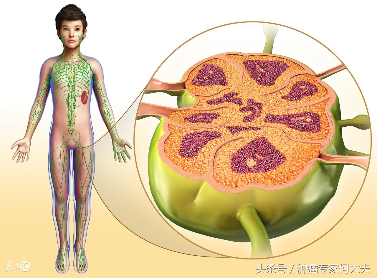 确诊是淋巴瘤要怎么办,淋巴瘤是怎样的血液病