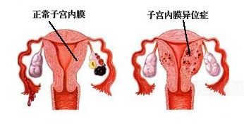 子宫内膜异位症科普一下,子宫内膜异位症最彻底的解决方法