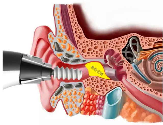 采耳可以自己带工具么,采耳可以随便弄吗