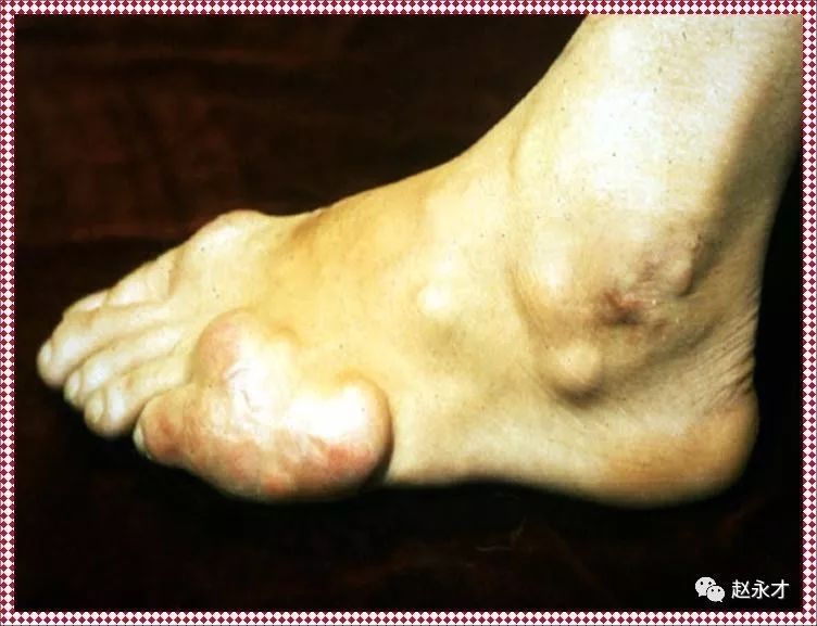 痛风中医讲座,教你一招根治痛风