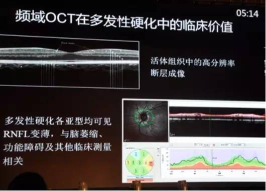 COFDS2016EthanPriel教授：多模式成像在神经眼科中的应用
