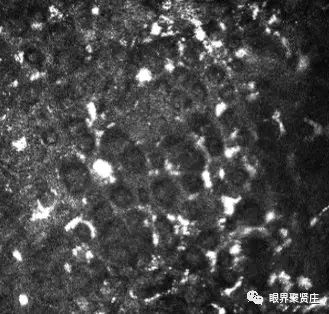 几种眼病的视野图,看图识病是什么病